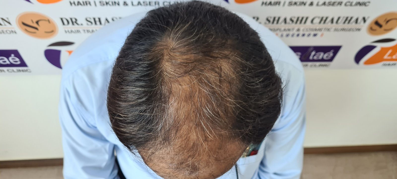 AK Singh Before Hair Transplant